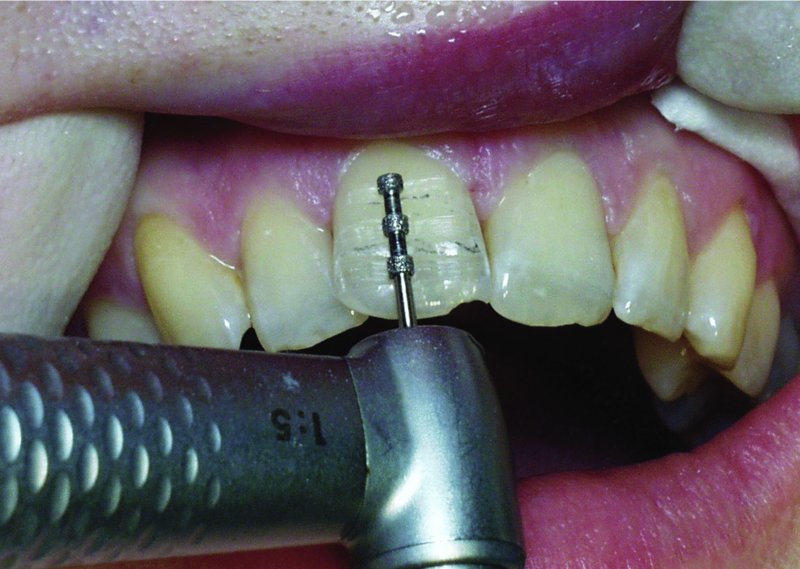 Tooth Preparation