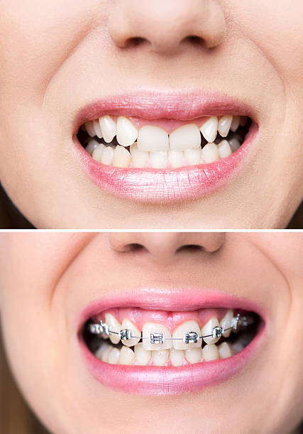 Upper Braces