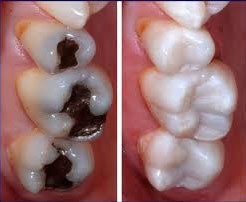 Permanent Fillings Light Cure
